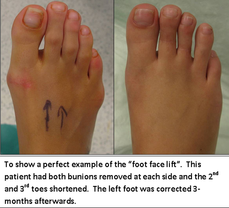 Featured image of post Cinderella Bunion Surgery