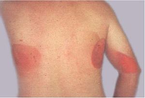 Featured image of post What Do Radiation Burns Look Like